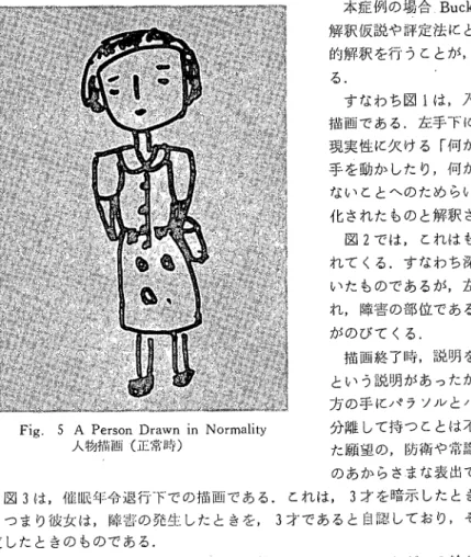 Fig. 5 Ａ Person Drawn in Normality     人物描匹ト(正常時) 159 本症例の場合Ｂｕck(1)やGoodenough''"の解釈仮説や評定法にとらわれることなく，象徴的解釈を行うことが，より有益であると思われる．  すなわち図１は，入院早期の第１[回面接時の描画である．左手下にみられる四角なものは，現実性に欠ける｢何か｣であり，障害のある左手を勣かしたり，何かを持ちたい，人並に出来ないことへのためらい等の願望や，葛藤の象徴化されたものと解釈される． 図２では，