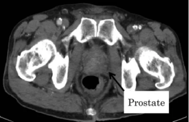 Fig. 1. Enhanced pelvic computed tomography scan showed the size of prostate at diagnosis (arrow)