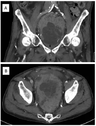 Fig. 3. Hematoxylin and eosin staining showed a pathological ﬁnding of needle biopsy with poorly differentiated adenocarcinoma  (Glea-son score 5 ＋ 4)in the giant prostate.