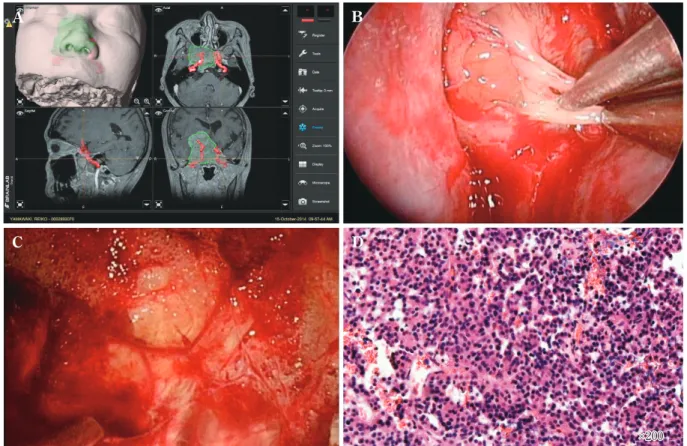 Fig. 2 Endoscopic endonasal surgical view with a navigation image and histopathology  A  ：Neuronavigation indicated the tumor location.