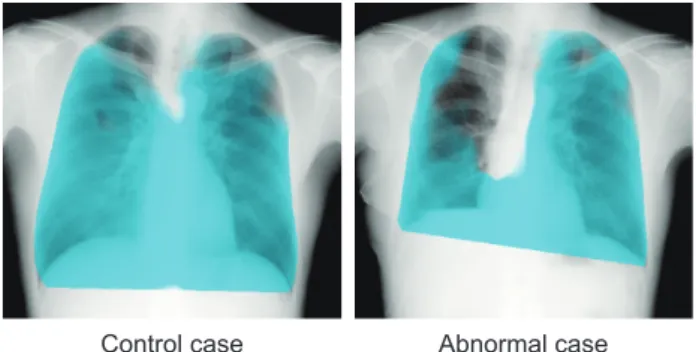 Fig. 6   Maximum inhalation frames in V mode (specific-signal’s variation  extracting processing) images, a control case, and a COPD patient