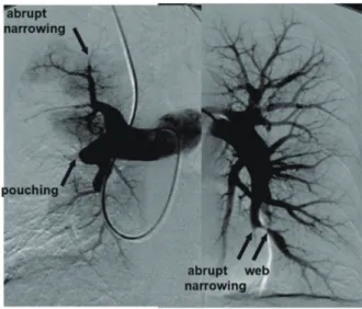 図 9 CTEPH の肺動脈造影 表 25  CTEPH の重症度基準 （新規申請時） 新規 申請時 自覚症状 mPAP PVR 安静時・室内気PaO2（Torr） 肺血管拡張薬使用