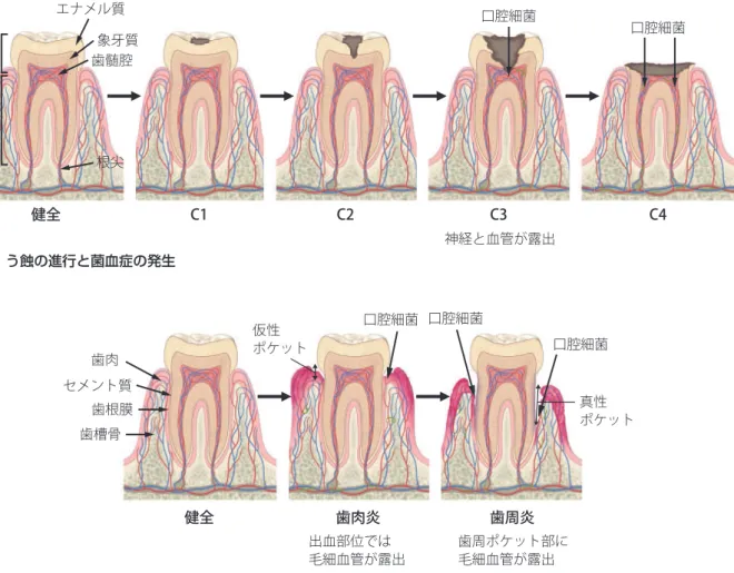 図 4 う蝕の進行と菌血症の発生健全 C1 C2 C3 C4歯冠歯根エナメル質象牙質歯髄腔 口腔細菌神経と血管が露出口腔細菌根尖 健全 歯肉炎 歯周炎歯肉セメント質歯根膜歯槽骨口腔細菌 口腔細菌 口腔細菌 出血部位では 毛細血管が露出 歯周ポケット部に毛細血管が露出 図 5 歯周病の進行と菌血症の発生 真性 ポケット仮性ポケット 種が知られているが，う蝕の原因菌である mutans group のレンサ球菌種である Streptococcus mutans もその 1 つで あることが報告されている 435