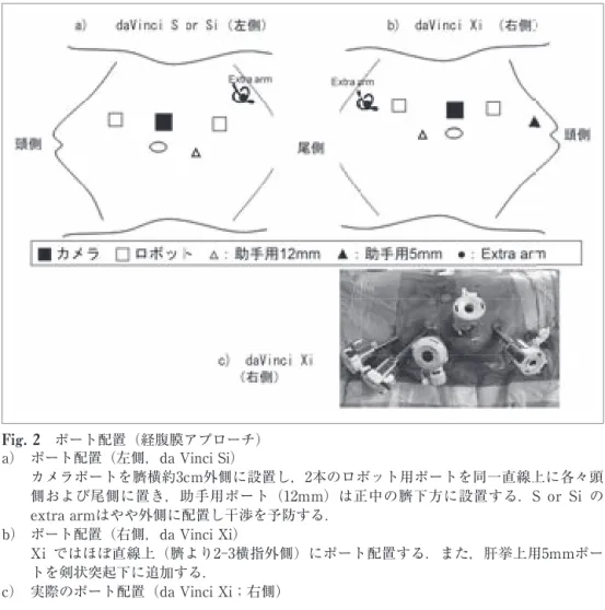 Fig. 2 　ポート配置（経腹膜アプローチ）