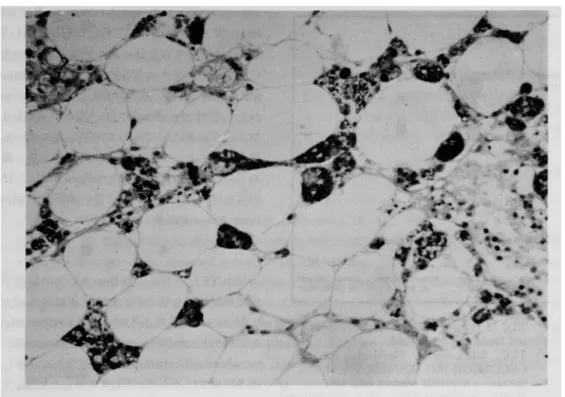 Fig.  2  Photomicrograph  of  a  bone  marrow  of  flank  bone  by  biopsy  (paraffin  embedding,  PAS  staining)