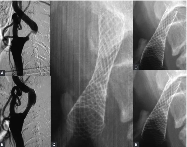 Fig. 3 A case with stent migration to the proximal side: a  75-year-old male with symptomatic stenosis  ( case  4) 