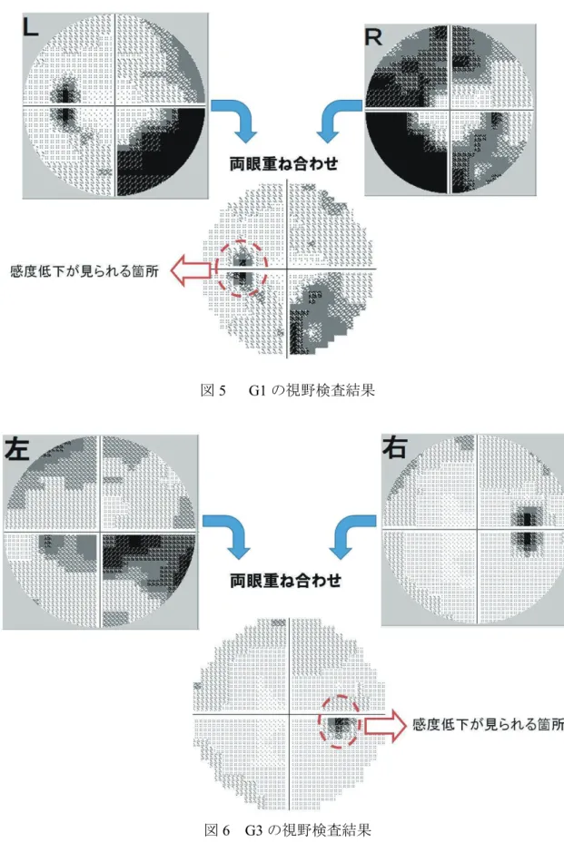 図 5   G1 の視野検査結果