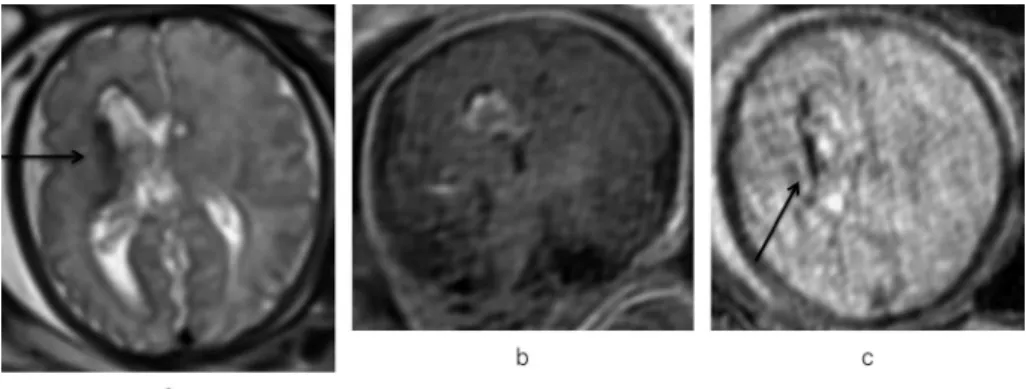Fig. 9. Fetus at 34 weeks of gestation with germinal matrix hemorrhage. T 2 WI (a) demonstrates abnormal hypointensity lining the germinal matrix (arrow), consistent with right germinal matrix hemorrhage