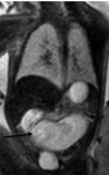 Fig. 14. Fetus at 37 weeks of gestation with jejunal atresia. Coronal T 2 WI shows dilated bowel loops with high intensity (arrow).