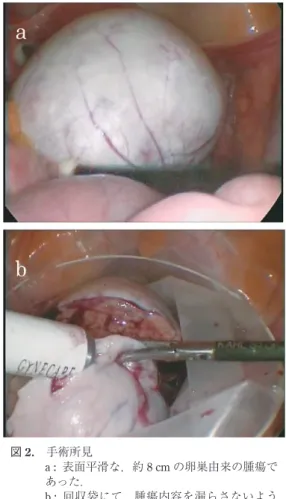 図 1. MRI 画像 A : T2 強調画像矢状断 B : T2 強調画像横 断 C : T1 強調画像横断 D : 脂肪抑制画像 矢印部分は T1 強調像・T2 強調像ともに高 信号で脂肪抑制を認め，dermoid cyst と考え られた． 図 2. 手術所見a : 表面平滑な，約 8 cm の卵巣由来の腫瘍であった．b :回収袋にて，腫瘍内容を漏らさないように腫瘍を摘出．充実性卵巣腫瘍であった．割面は黄白色で，一部脂肪成分を含んでいた．図3. 手術標本モルセレーターにて回収し，ホルマリン固定後の標本
