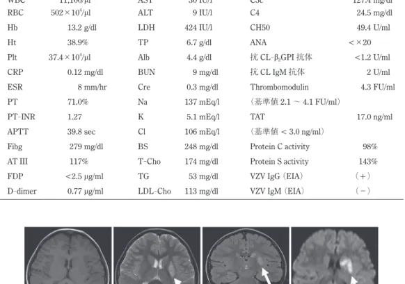 図 1. 脳 MRI 画像    A : 第 2 病日（T1 強調画像）異常所見を認めない．    B : 第 2 病日（T2 強調画像）左レンズ核から尾状核に淡い高信号域を認める（矢印）．    C : 第 2 病日（FLAIR 画像）左レンズ核から尾状核に淡い高信号域を認める（矢印）．    D : 第 2 病日（拡散強調画像）左レンズ核から尾状核に高信号域を認める（矢印）．    E : 発症 6 カ月後（T1 強調画像）左レンズ核から尾状核に低信号域を認める（矢印）．    F : 発症 6 カ月後