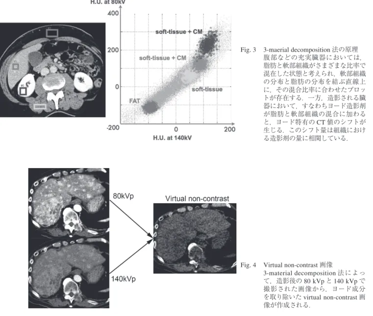 Fig. 4  Virtual non-contrast 画像