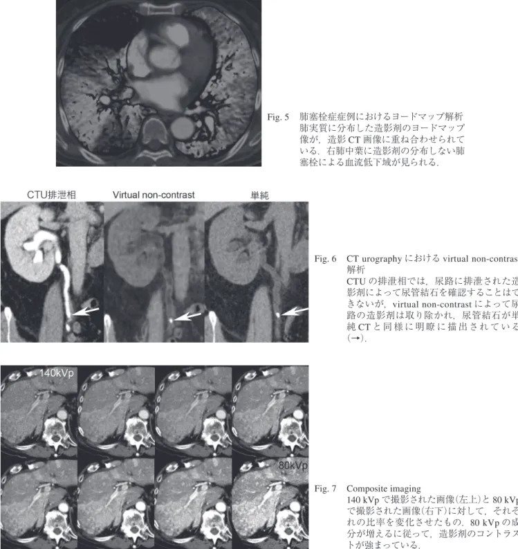 Fig. 6  CT urography における virtual non-contrast 解析 CTU の排泄相では，尿路に排泄された造 影剤によって尿管結石を確認することはで きないが，virtual non-contrast によって尿 路の造影剤は取り除かれ，尿管結石が単 純 CT と同 様 に 明 瞭 に 描 出 され て い る （→）．