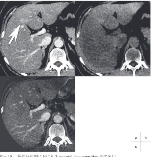 Fig. 10  脂肪肝症例における 3-material decomposition 法の応用