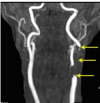 図 1  CAS 直後の頸部 TOF-MRA（maximum intensity  projection:MIP 像）ではステント部は信号欠損になり描出 されない。 されている。また、9 例では CAS 前にも VISTA 法 での評価が施行されている。撮像は 1.5Ｔ超伝導装 置  （Achieva・Philips 社製）にて、 8ch NVcoil  を 用いて行った。撮像条件は、  TOF-MRA（FOV:240mm×240mm, Matrix:272× 122, ReconVoxel size: 0
