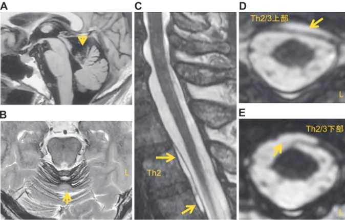 Fig. 1 脳表へモジデリン沈着症（superficial (hemo) siderosis，以下 SS と略記）．