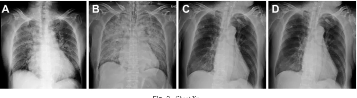 Fig. 2 Chest Xp.