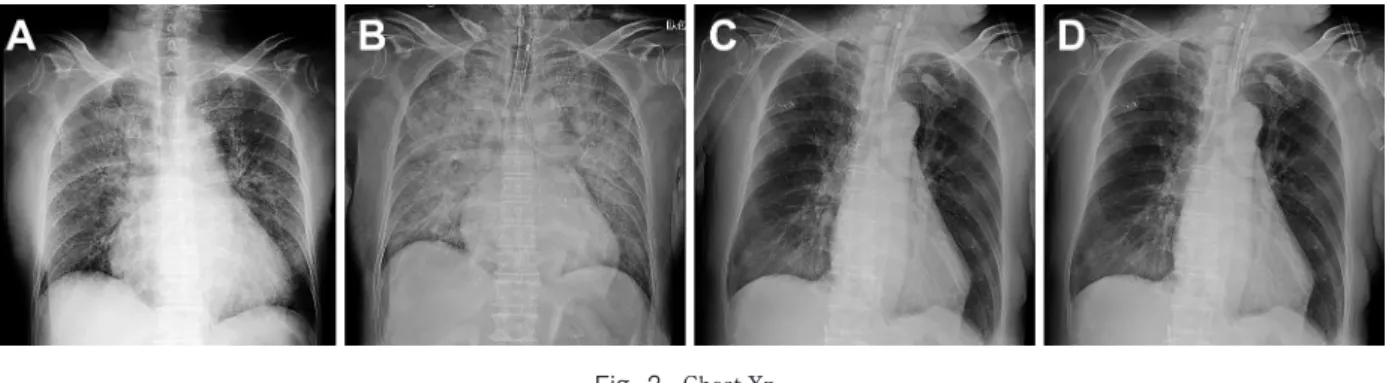 Fig. 2 Chest Xp.