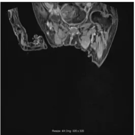 Fig. TSE DIXON(左)と VIBE DIXON(右)を撮影した症例。 