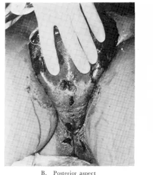 Fig.  2  The  peno-scrotal  area  was  covered  with  clusters  of  necrotic  tissues, ulcers,  and  vesicles  with or  without  rupture  during  the  following  12  hours