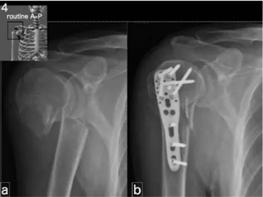 図 4　上腕近位骨折 -3fracture of the proximal  humerus a  近位骨片は棘上筋によ り外転，遠位骨片は大胸筋 により内旋。 b  骨頭にはタイトなスク リューホール，骨幹部には ルーズなスクリューホール のあるプレートを使用し， マイクロモーションを期待 した固定術。 図 5　烏口突起骨折  fracture of the processus  coracoideus a  烏口突起基部外側に骨 折線（△）が認められるが， 骨片変位（-），肩鎖関節に 脱臼傾向（→） 。