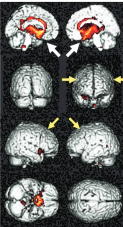 図 1 対照群と，うつ群・高次脳機能障害の結果比較