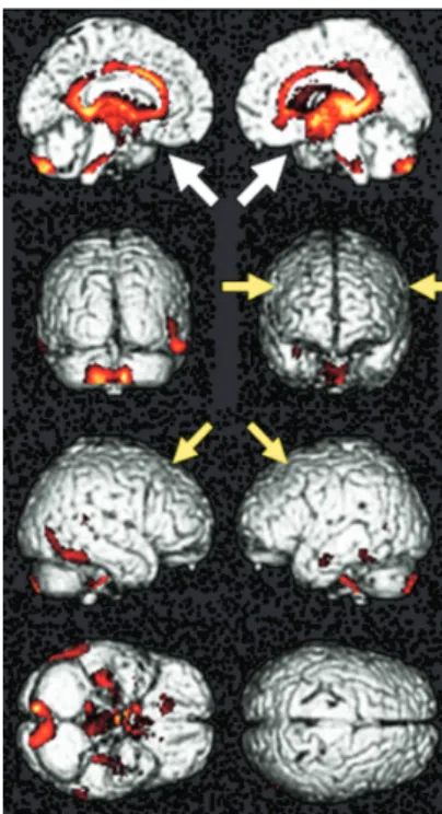 図 2 うつ群と高次脳機能障害群の結果の直接比較