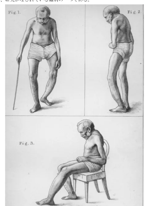 Figure 2-2-2.  骨パジェット病患者のスケッチ   ( 論文 2-2-2) より引用 ) 