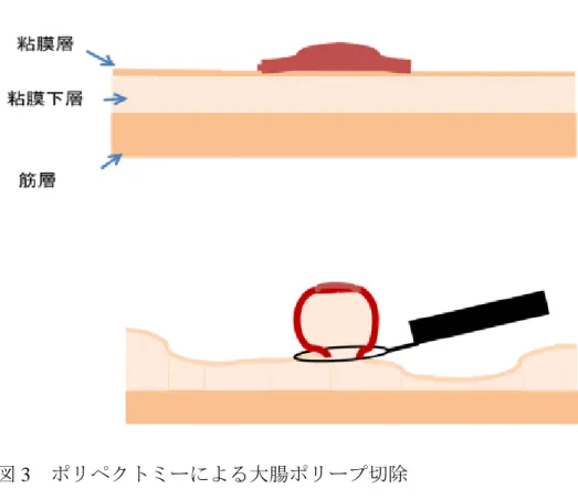 図 3  ポリペクトミーによる大腸ポリープ切除 