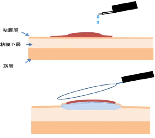 図 4  EMR による大腸ポリープ切除 
