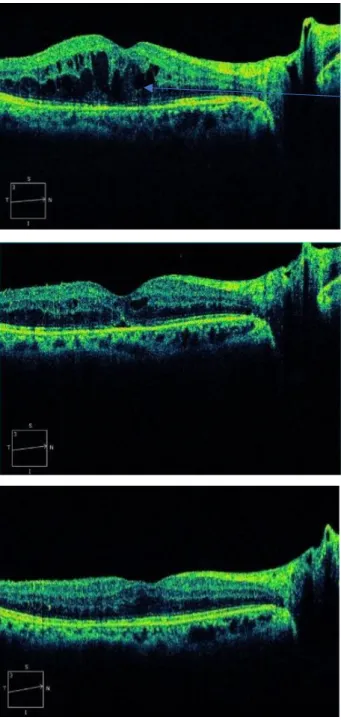 Figure 7.  糖尿病黄斑浮腫に対して抗 Vascular Endothelial Growth Factor 