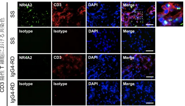 図 7    口唇唾液腺（ labial salivary gland: LSG ）の蛍光免疫染色： NR4A2 、 CD3  シェーグレン症候群（Sjögren's syndrome: SS）患者と IgG4 関連疾患（IgG4-related  disease: IgG4-RD）患者の LSG 切片を用い、NR4A2 と CD3 の二重染色を行った。