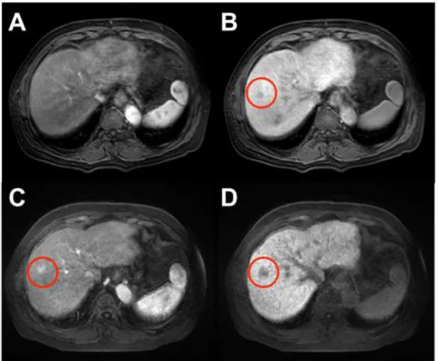 Figure 3. A representative case of hypervascularization of non-hypervascular  hypointense nodules in patients with hepatocellular carcinoma as detected by  gadolinium-ethoxybenzyl-diethylenetriamine pentaacetic acid (Gd-EOB-DTPA)  enhanced MRI
