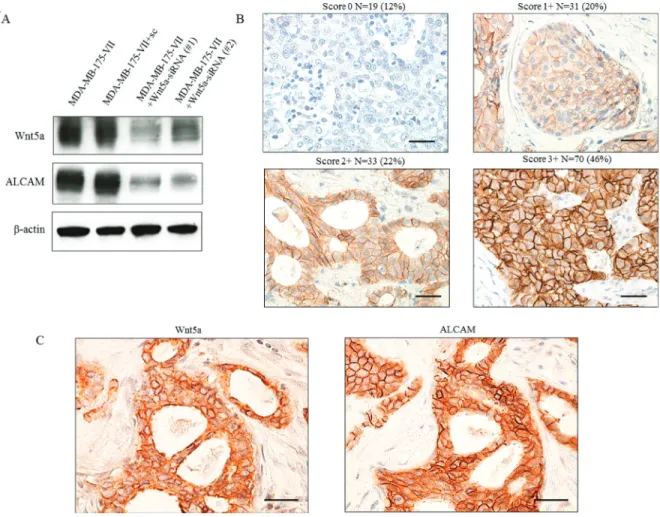 Table 4: Relationship between Wnt5a expression and ALCAM expression in ER-positive breast cancer ALCAM