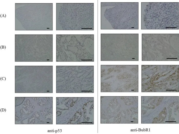 Figure 7. Expression of p53 and BubR1 in gastric cancer.     