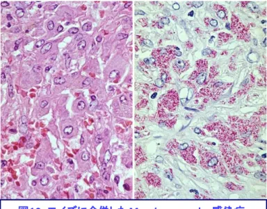 図 10 ：エイズに合併した M. avium complex 感染症 （肺門リンパ節病変、左： HE 染色、右： Ziehl-Neelsen 染色） 好酸性細胞質を有するマクロファージがびまん性に増生し、細 胞質が横紋状を呈している（左）。抗酸菌染色では、このstriated  histiocyteの細胞質に、抗酸性を示す大型桿菌が充満している。 細胞性免疫不全状態における特徴的な病変である。 ８．放線菌症、ノカルジア症  放線菌 Actinomyces israerii はグラ ム陽性で嫌気性フィラメン