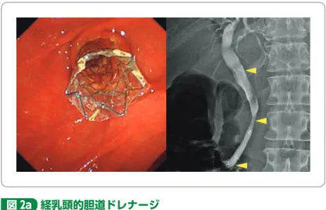 図 2a 経乳頭的胆道ドレナージ 遠位胆管癌に対する FCSEMS による経乳頭的ドレナージ 図 2b  EUS-BD 主に十二指腸球部から穿刺する EUS-CDS と胃から肝内 胆管を穿刺する EUS-HGS が行われる。 EUS-HGSEUS-CDS胆管を穿刺する超音波内視鏡下肝胃瘻孔形成術（EUS hepaticogastrostomy：EUS-HGS）が あ る。2012年より本邦においても保険適用となり近年急速に発達している低侵襲治療の一つである。しかし，合併症としては腹膜炎とステント逸脱が重大で