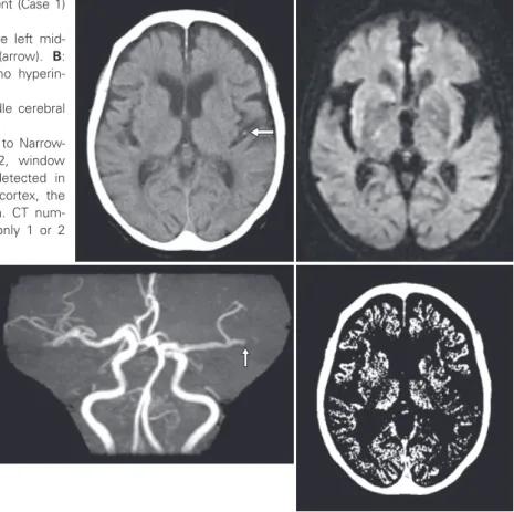 Fig.  1　 CT and MRI images of a 92-year-old patient (Case 1)  1  h  after  stroke  onset