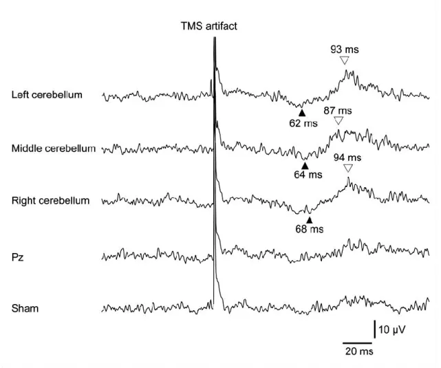 Fig. 1. 7 Averaged rectified EMG traces for each condition. On set  latency (filled triangles) and peak latencies (open triangles) are  shown for the cerebellar TMS conditions