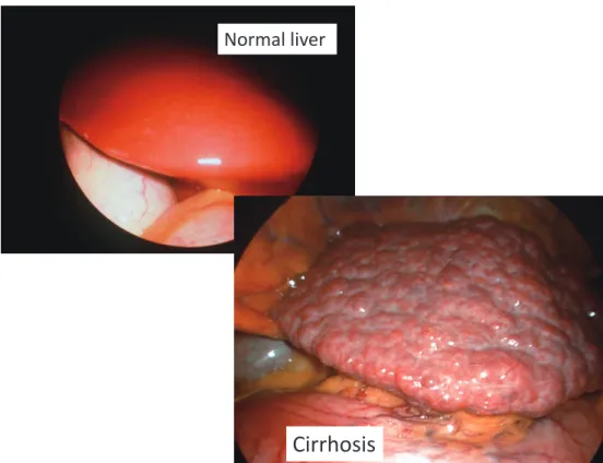 Table　1　Liver blood tests