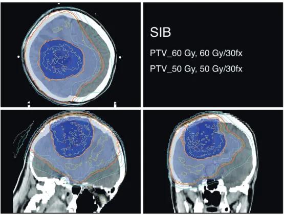 Fig. 4 VMAT plan for postoperative brain tumor 