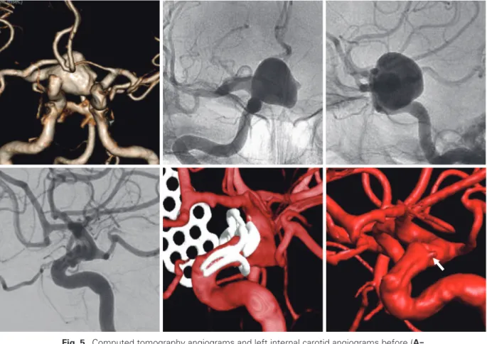 Fig. 5  Computed tomography angiograms and left internal carotid angiograms before (A - -C) and after the operation (D - F) in Case 3, showing the successful occlusion of a  large paraclinoid aneurysm with two aneurysm clips