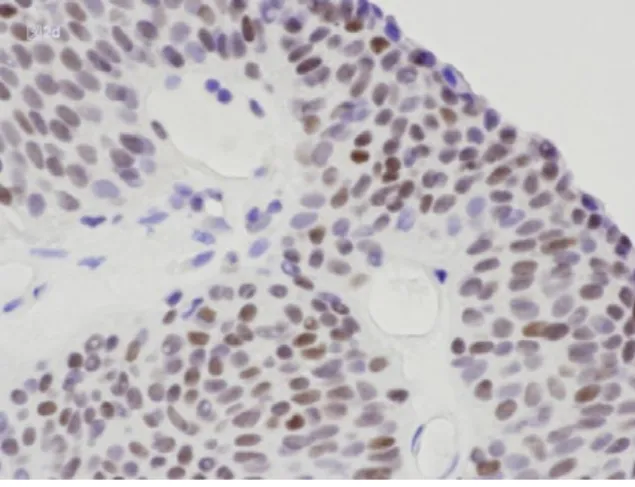 図 2c  非浸潤性尿路上皮癌における EGFR  図 2d  連続切片における p53   腫瘍細胞の膜に沿って強い反応が見ら  腫瘍細胞の核に反応が見られる。  れる。  図 2e  浸潤癌例における EGFR  図 2f  連続切片における p53   図 2c と同様の反応が認められる。  腫瘍細胞の核に反応が見られる。図 2d よりもその反応は強く彌慢性である。  尿細胞診標本への応用 この基礎検討の結果に基づき、日常検査に提出された尿細胞診標本へ EGFR、p53 を応用して みた。染色は EG