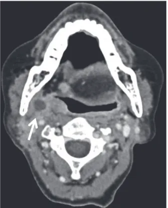 図 8 副咽頭郭清・内側翼突筋切除術を施行した症例の術前後 MRI 画像