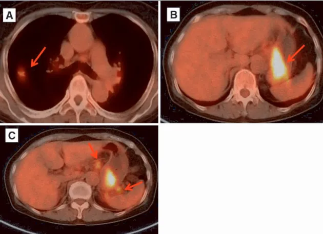Fig. 2 FDG-PET:  A:  A  lung  tumor  had  moderate  uptake  of  fluorodeoxyglucose  (SUV=4.1)