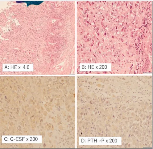 Fig. 7 Microscopic  findings  of  the  resected  gastric  tumor.  A:  HE  staining  showed  diffuse infiltration of tumor cells (×40)