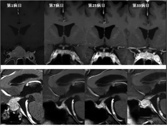 図 1. 造影 MRI （第 1 病日：全脳条件、第 7、25、33 病日：下垂体条件）