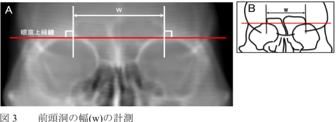 図 3      前頭洞の幅(w)の計測  A)  実際の RaySum 像上で前頭洞の幅  (w)の測定部位を示す.   B)  模式図上で前頭洞の幅  (w)を示す.  図 4      頂点位置(t)の計測  A)  実際の RaySum 像上で前頭洞の頂点位置  (t)の測定部位を示す