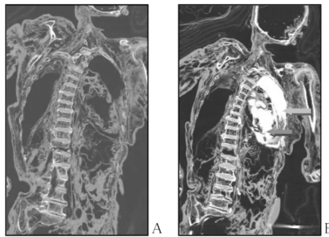 Fig. 1 Coronal maximum intensity projection (MIP) view of body  showing gas-filled organ and soft tissues [A]