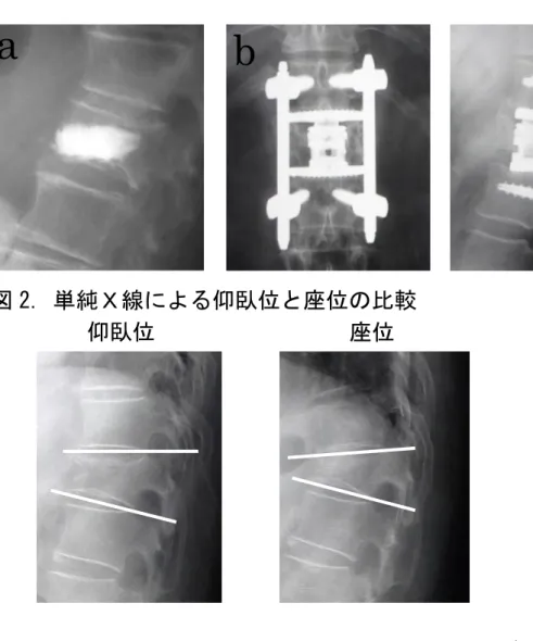 図 1. BKP(Balloon Kyphoplasty)(a）と  低侵襲前方後方再建術(X-core2®)（b）  図 2. 単純Ｘ線による仰臥位と座位の比較  図 3